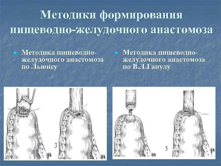 Методики формирования пищеводно-желудочного анастомоза n Методика пишеводножелудочного анастомоза по Льюису n Методика пишеводножелудочного анастомоза