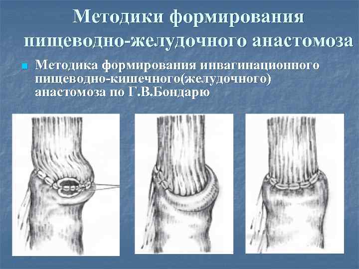 Методики формирования пищеводно-желудочного анастомоза n Методика формирования инвагинационного пищеводно-кишечного(желудочного) анастомоза по Г. В. Бондарю
