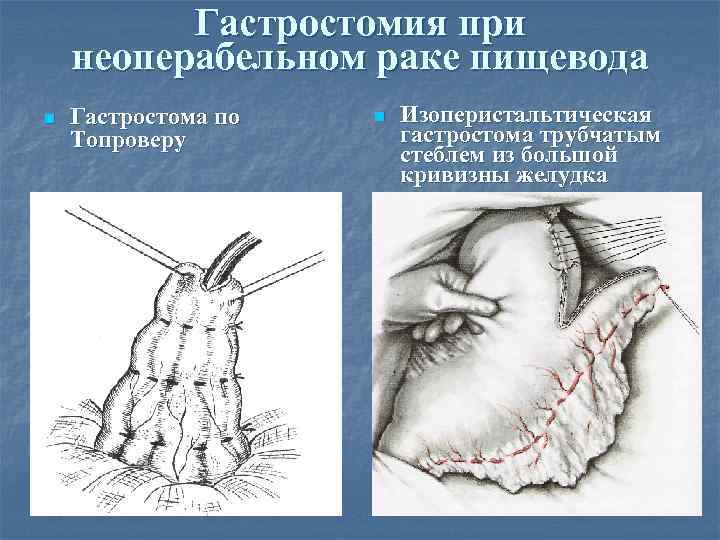 Гастростомия при неоперабельном раке пищевода n Гастростома по Топроверу n Изоперистальтическая гастростома трубчатым стеблем