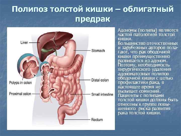 Полипоз толстой кишки – облигатный предрак Аденомы (полипы) являются частой патологией толстой кишки. Большинство