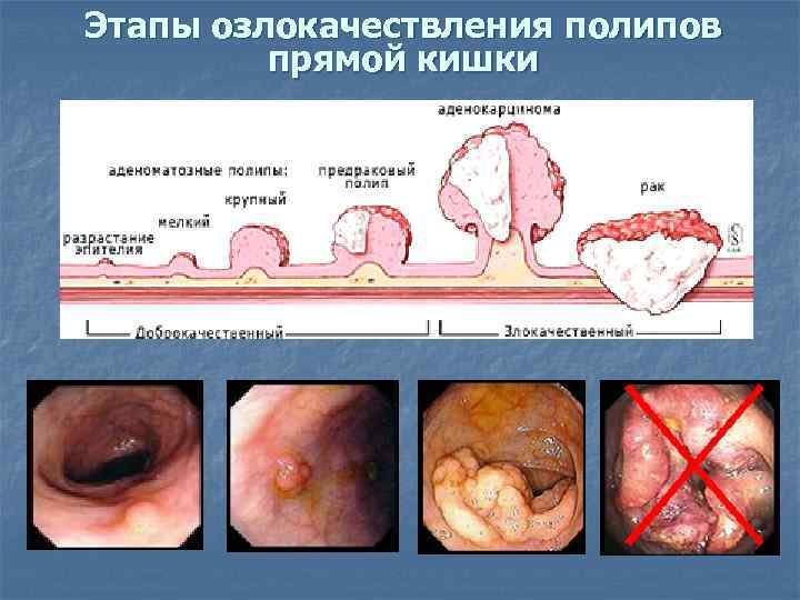 Этапы озлокачествления полипов прямой кишки 