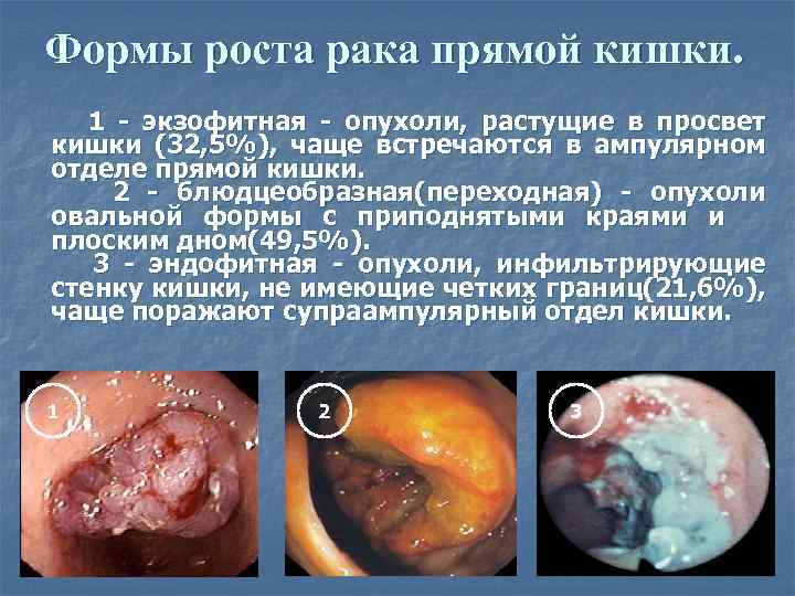 Формы роста рака прямой кишки. 1 - экзофитная - опухоли, растущие в просвет кишки