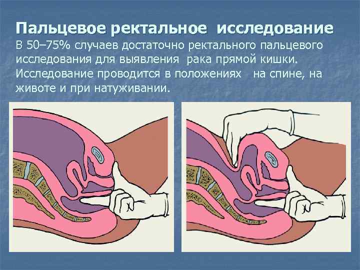 Пальцевое ректальное исследование В 50– 75% случаев достаточно ректального пальцевого исследования для выявления рака