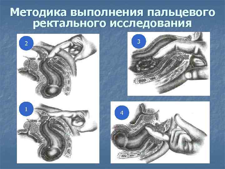 Методика выполнения пальцевого ректального исследования 3 2 1 4 