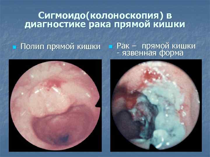 Сигмоидо(колоноскопия) в диагностике рака прямой кишки n Полип прямой кишки n Рак – прямой