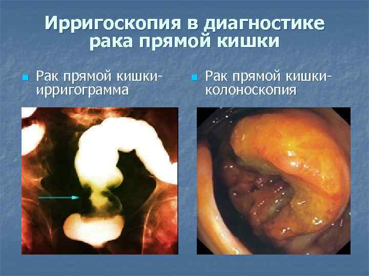 Ирригоскопия в диагностике рака прямой кишки n Рак прямой кишкиирригограмма n Рак прямой кишкиколоноскопия