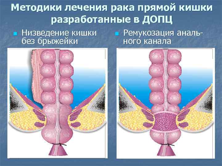 Методики лечения рака прямой кишки разработанные в ДОПЦ n Низведение кишки без брыжейки n