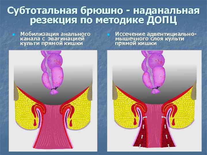 Субтотальная брюшно - наданальная резекция по методике ДОПЦ n Мобилизация анального канала с эвагинацией