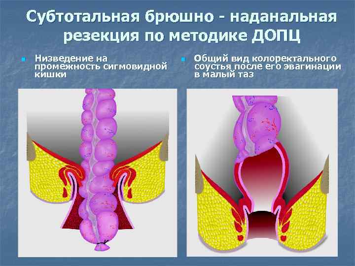 Субтотальная брюшно - наданальная резекция по методике ДОПЦ n Низведение на промежность сигмовидной кишки