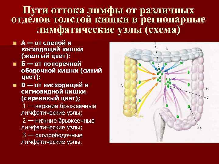 Пути оттока лимфы от различных отделов толстой кишки в регионарные лимфатические узлы (схема) А