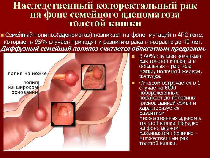 Наследственный колоректальный рак на фоне семейного аденоматоза толстой кишки n Семейный полипоз(аденоматоз) возникает на
