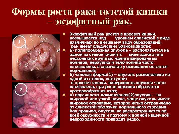 Формы роста рака толстой кишки – экзофитный рак. n 1 n n 2 n