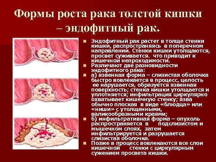 Формы роста рака толстой кишки – эндофитный рак. n n n Эндофитный рак растет