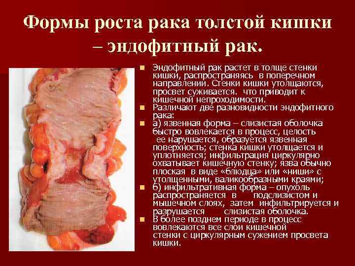 Формы роста рака толстой кишки – эндофитный рак. n n n Эндофитный рак растет