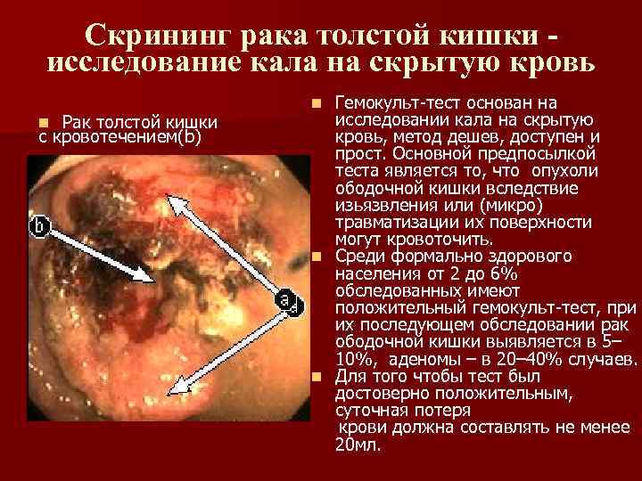 Скрининг рака толстой кишки исследование кала на скрытую кровь Рак толстой кишки с кровотечением(b)