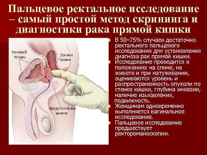 Пальцевое ректальное исследование – самый простой метод скрининга и диагностики рака прямой кишки В