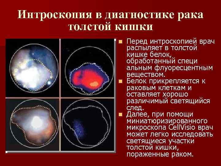 Интроскопия в диагностике рака толстой кишки Перед интроскопией врач распыляет в толстой кишке белок,