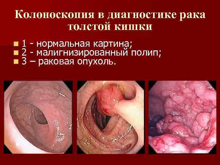 Колоноскопия в диагностике рака толстой кишки n 1 n 2 n 3 - нормальная