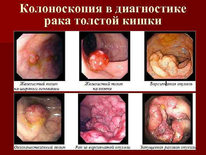 Колоноскопия в диагностике рака толстой кишки 