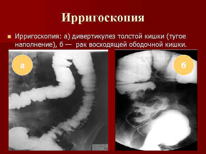 Ирригоскопия n Ирригоскопия: а) дивертикулез толстой кишки (тугое наполнение), б — рак восходящей ободочной