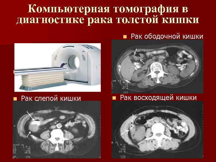 Компьютерная томография в диагностике рака толстой кишки n n Компьютерный томограф n Рак слепой