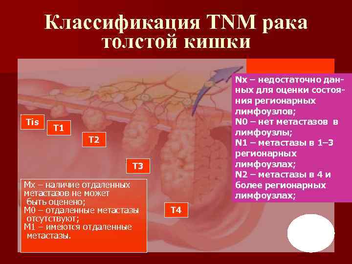 Классификация TNM рака толстой кишки Tis Nх – недостаточно данных для оценки состояния регионарных