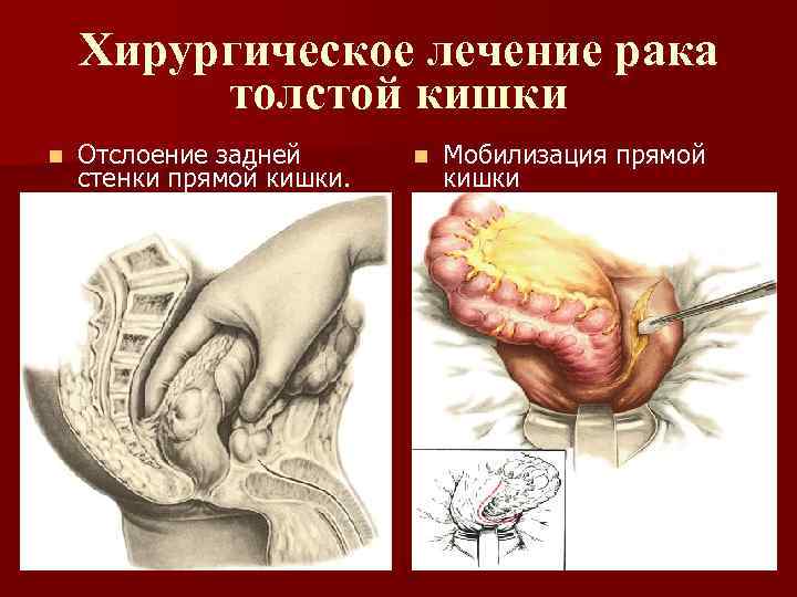Хирургическое лечение рака толстой кишки n Отслоение задней стенки прямой кишки. n Мобилизация прямой