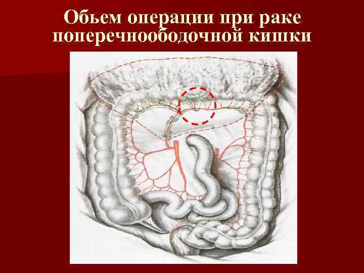 Обьем операции при раке поперечноободочной кишки 