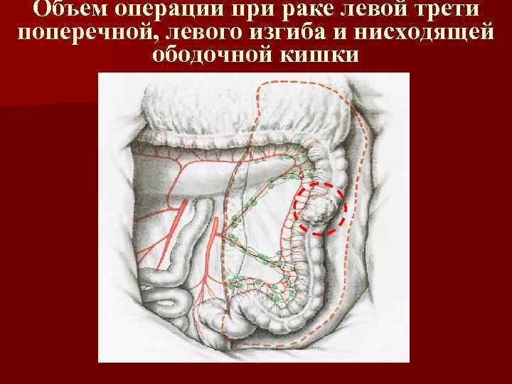 Объем операции при раке левой трети поперечной, левого изгиба и нисходящей ободочной кишки 