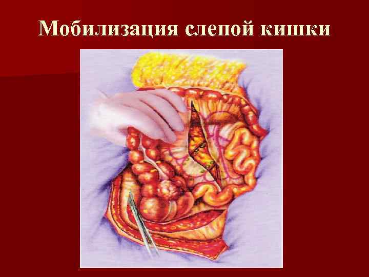 Мобилизация слепой кишки 