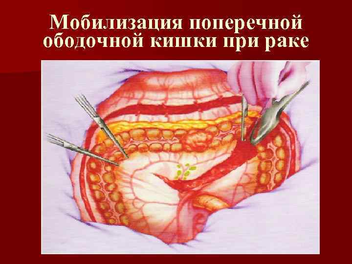 Мобилизация поперечной ободочной кишки при раке 