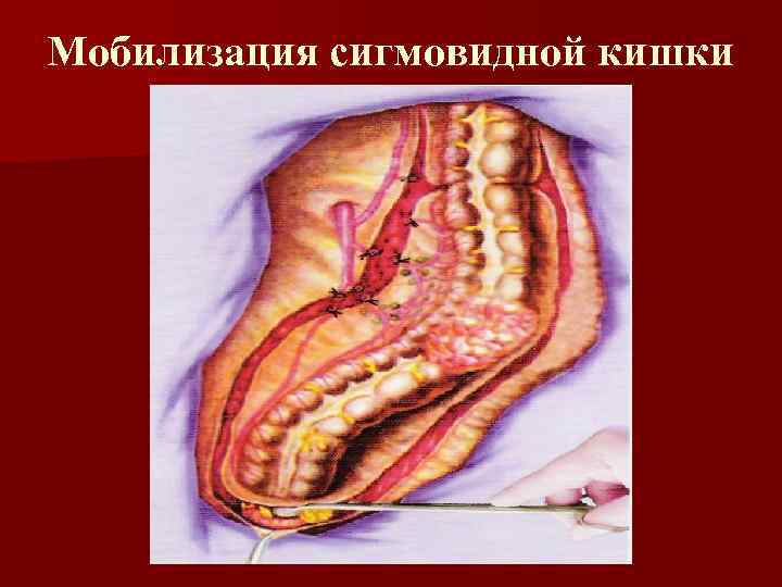 Мобилизация сигмовидной кишки 