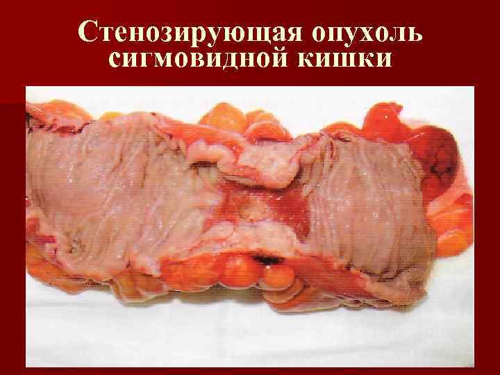 Стенозирующая опухоль сигмовидной кишки 