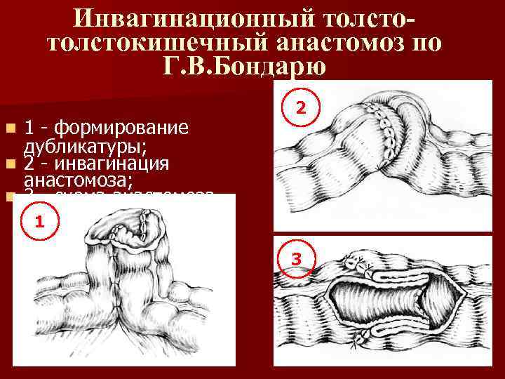 Инвагинационный толстокишечный анастомоз по Г. В. Бондарю 1 - формирование дубликатуры; n 2 -