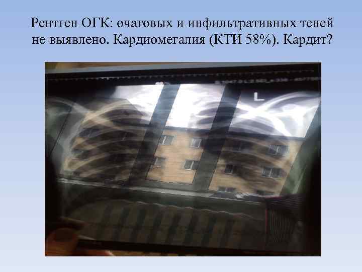 Рентген ОГК: очаговых и инфильтративных теней не выявлено. Кардиомегалия (КТИ 58%). Кардит? 