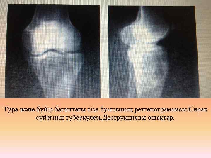 Тура және бүйір бағыттағы тізе буынының ретгенограммасы: Сирақ сүйегінің туберкулезі. Деструкциялы ошақтар. 