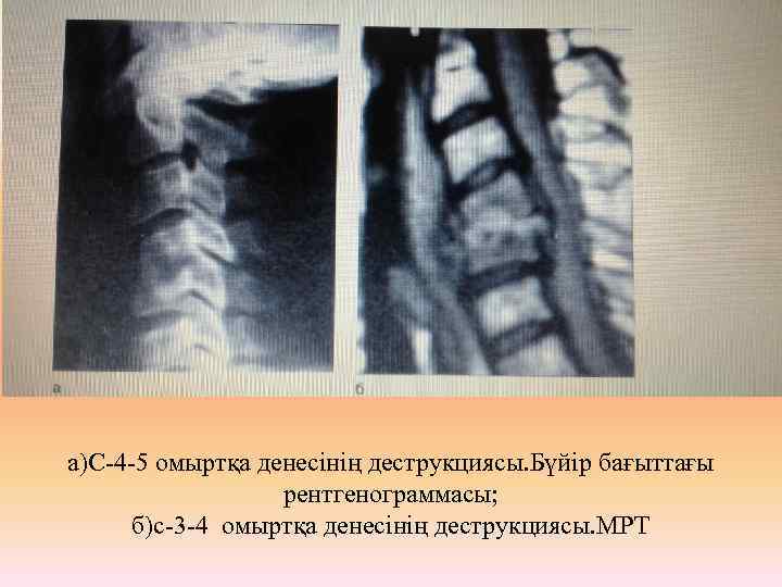 а)С-4 -5 омыртқа денесінің деструкциясы. Бүйір бағыттағы рентгенограммасы; б)с-3 -4 омыртқа денесінің деструкциясы. МРТ