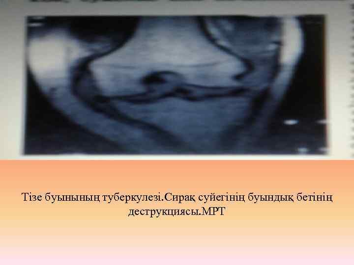 Тізе буынының туберкулезі. Сирақ суйегінің буындық бетінің деструкциясы. МРТ 