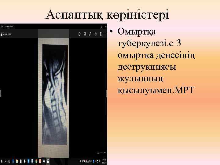 Аспаптық көріністері • Омыртқа туберкулезі. с-3 омыртқа денесінің деструкциясы жулынның қысылуымен. МРТ 