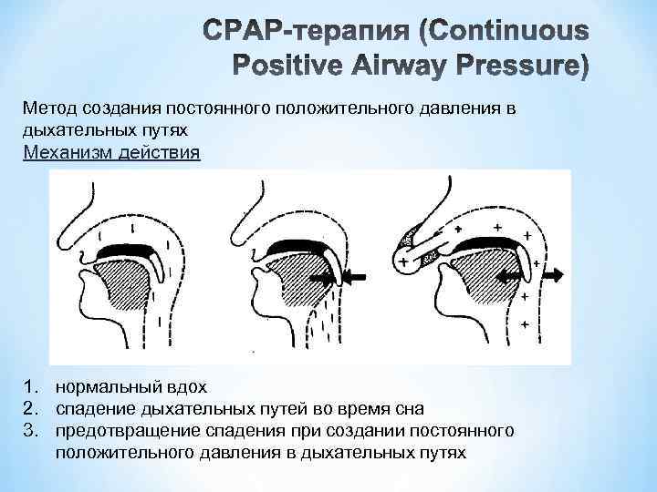Метод создания постоянного положительного давления в дыхательных путях Механизм действия 1. нормальный вдох 2.
