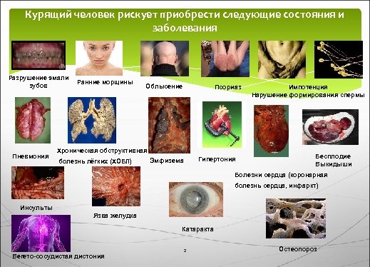 Курящий человек рискует приобрести следующие состояния и заболевания Разрушение эмали зубов Пневмония Ранние морщины