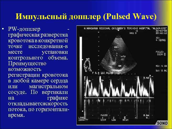 Импульсный допплер (Pulsed Wave) • PW-допплер графическая разверстка кровотока в конкретной точке исследования-в месте