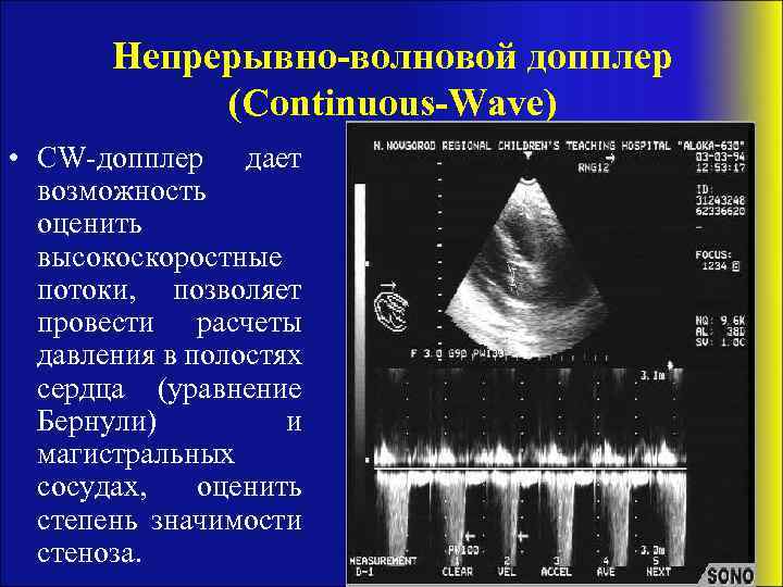 Непрерывно-волновой допплер (Continuous-Wave) • CW-допплер дает возможность оценить высокоскоростные потоки, позволяет провести расчеты давления