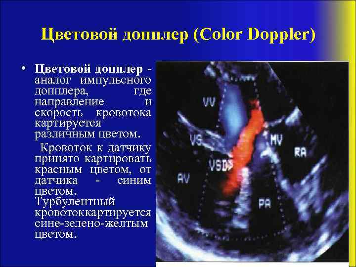 Цветовой допплер (Color Doppler) • Цветовой допплер аналог импульсного допплера, где направление и скорость