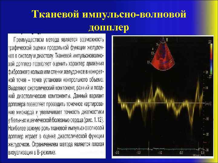 Тканевой импульсно-волновой допплер 