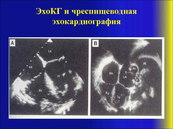 Эхо. КГ и чреспищеводная эхокардиография 