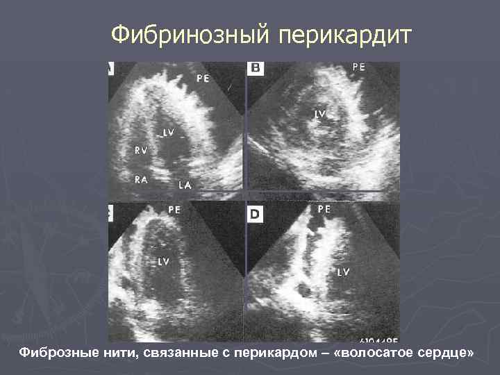 Фибринозный перикардит Фиброзные нити, связанные с перикардом – «волосатое сердце» 