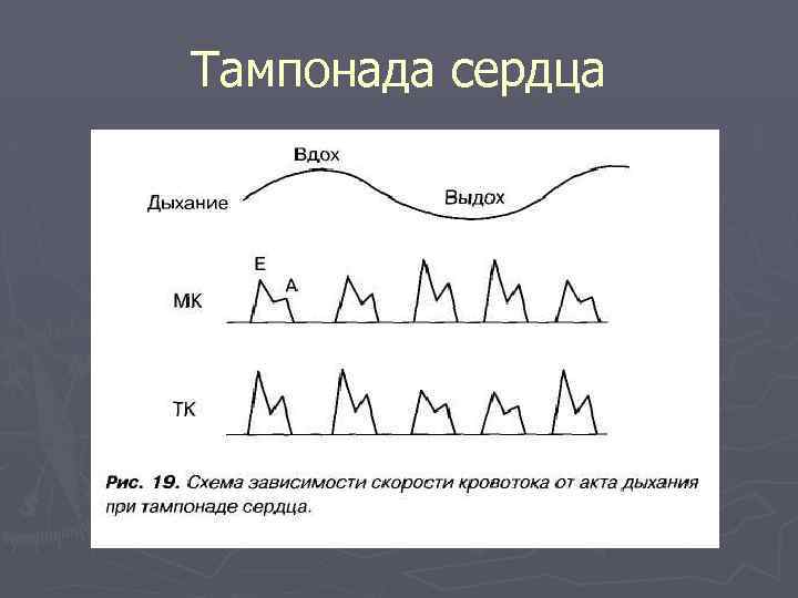 Тампонада сердца 