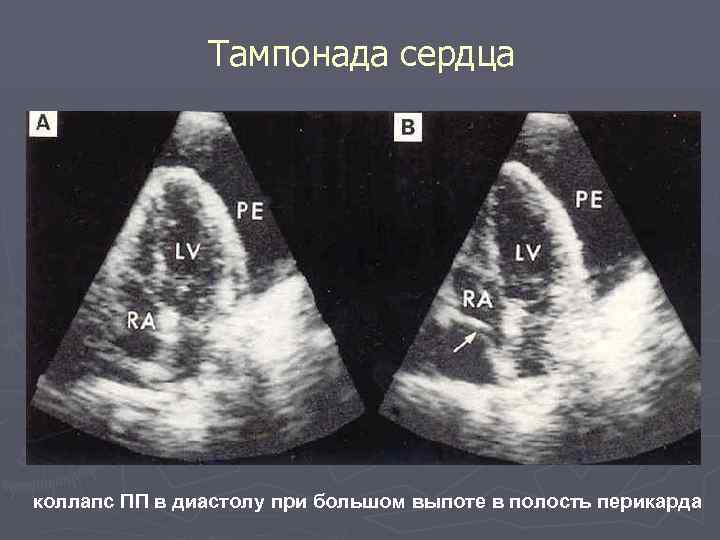 Тампонада сердца коллапс ПП в диастолу при большом выпоте в полость перикарда 