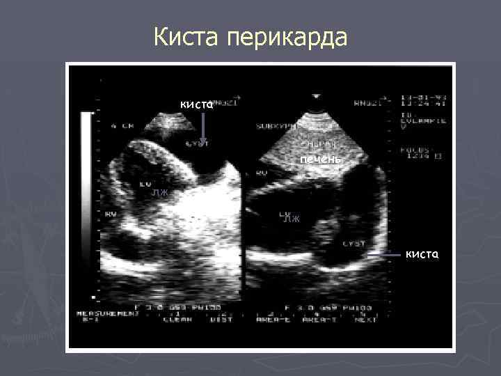 Киста перикарда киста печень лж лж киста 
